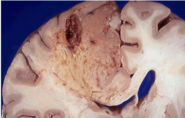 <p>Liquefactive necrosis causes (Form of Necrosis)</p>
