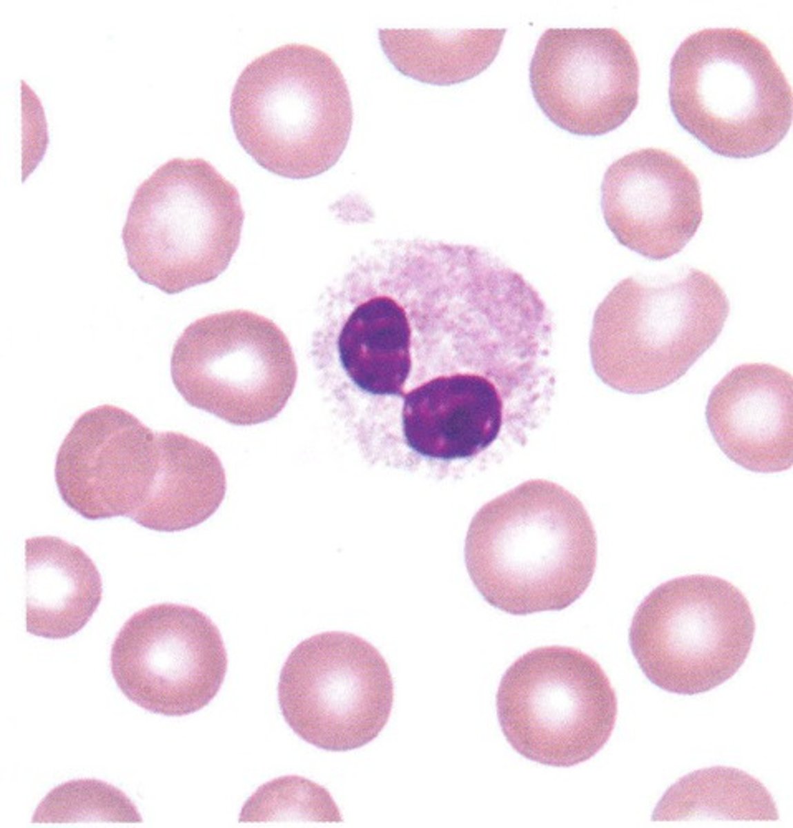<p>inherited, bi-lobed neutrophils in PB</p><p>- benign condition with no clinical manifestations</p><p>Pseudo Pelger Huet = only some neutrophils have bilobed nuclei</p><p>- a toxic change</p><p>- assoc w toxic granulation, degranulation, left shift, MDS, etc.</p>