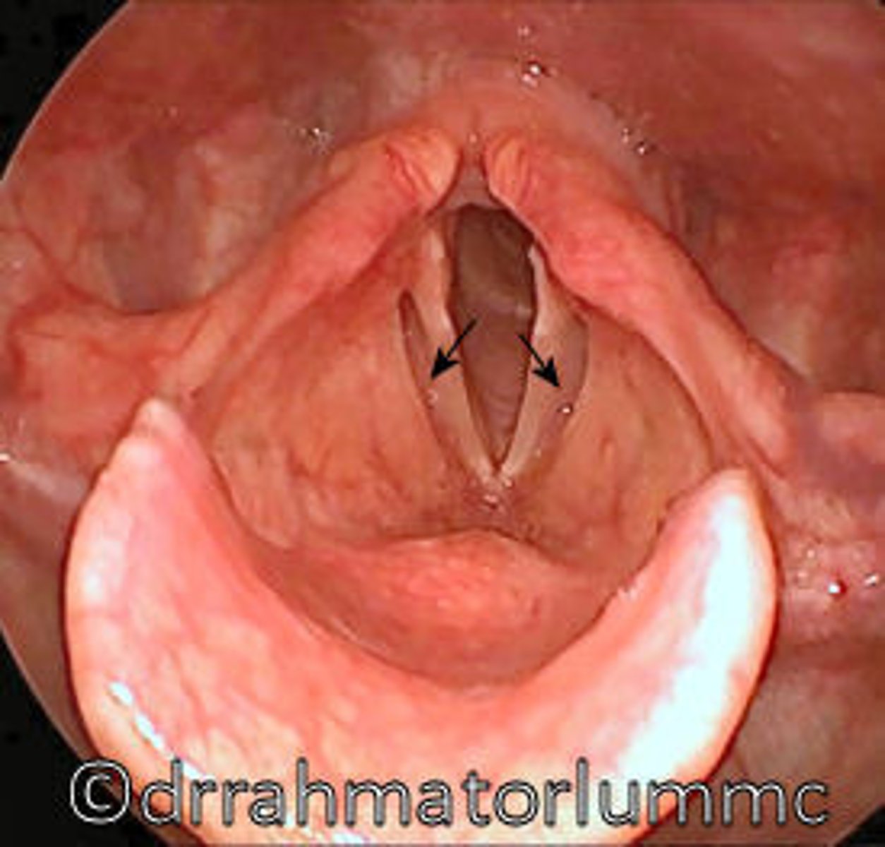 <p>space between true and false vocal folds</p>