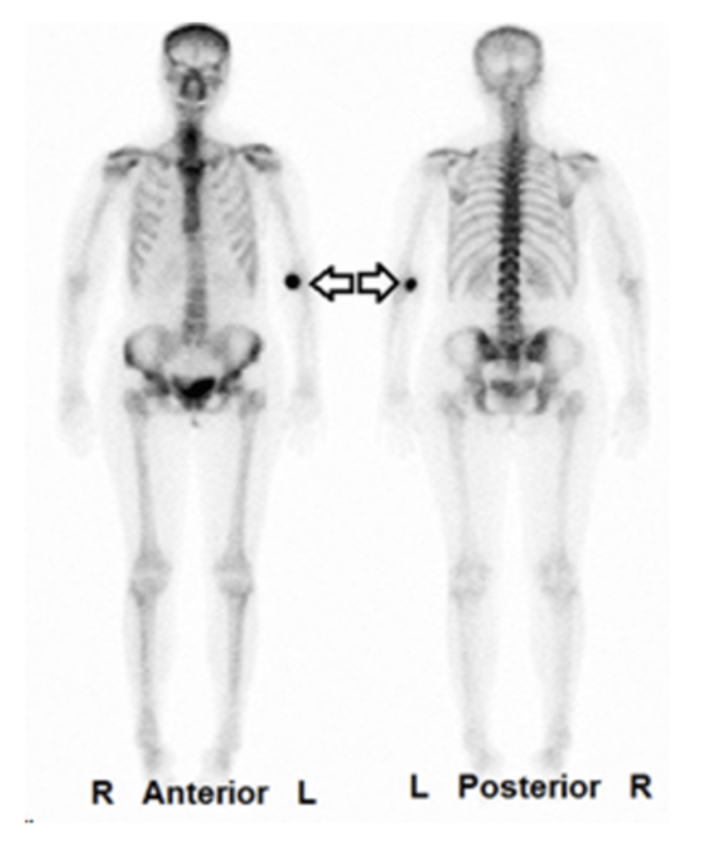 <p>this is where the patient was injected and some radiopharmaceutical is left at the injection site</p>