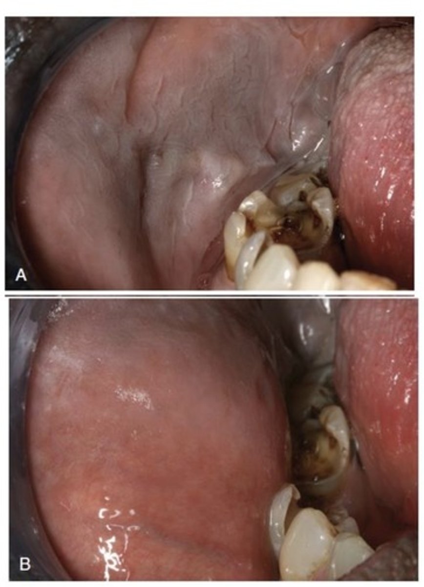 <p>How does Leukodema appear? What is it typically? </p>