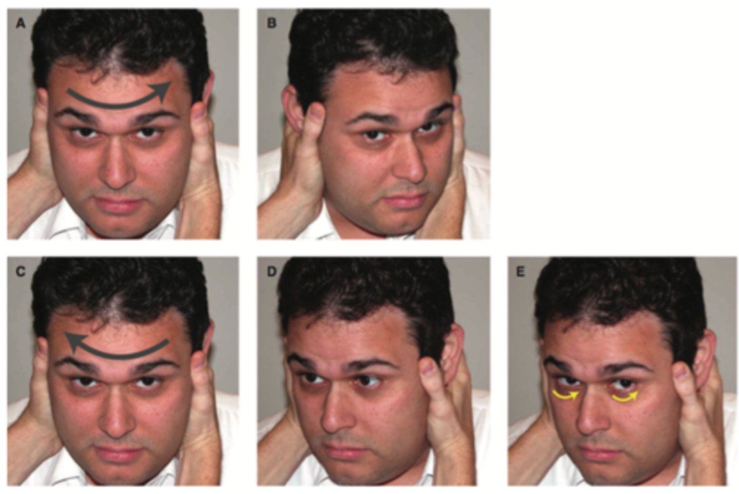 <p>patients with peripheral vertigo will have abnormal (positive) head impulse testing</p><p>patients with central vertigo typically have a normal (negative) head impulse test</p><p>- reassuring if abnormal (corrective saccades)</p>