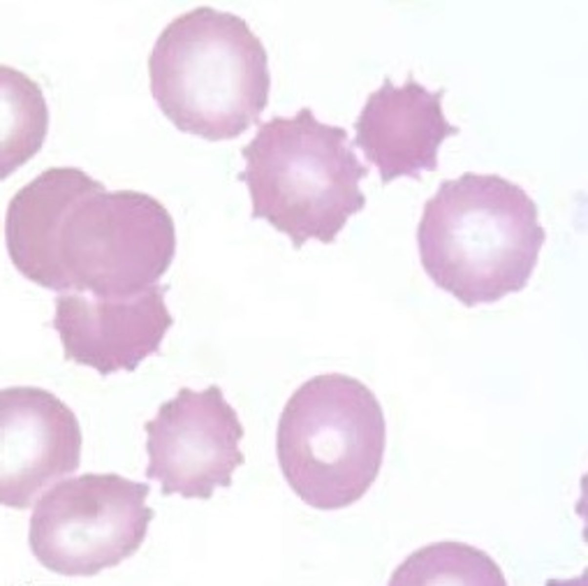 <p>Uraemia</p><p>Pyruvate kinase deficiency</p>