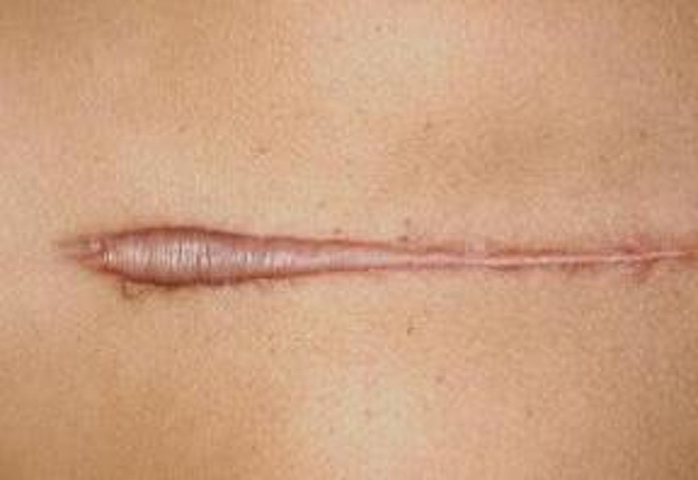 <p>Thick scar resulting from excessive growth of fibrous tissue</p>