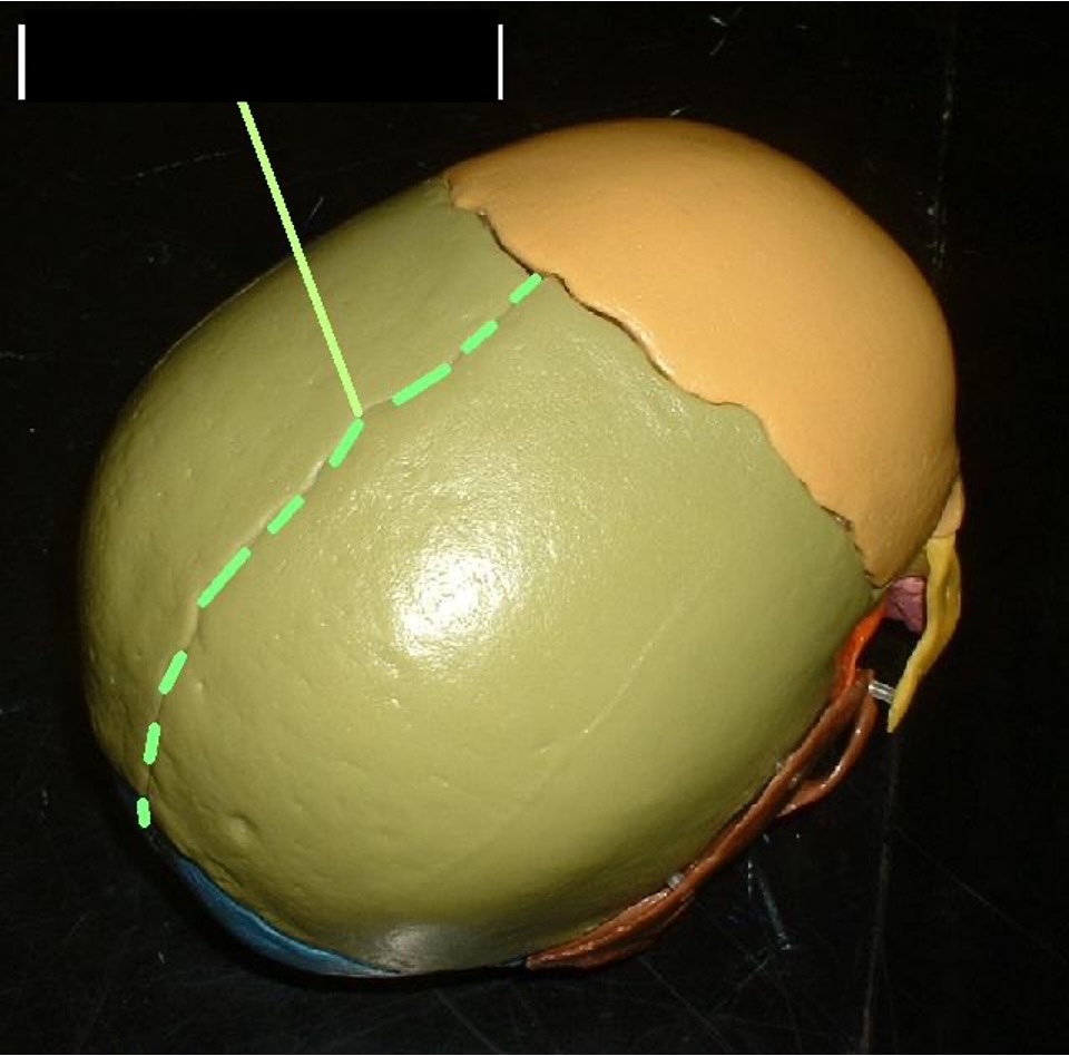 <p>mid-sagittal suture separating the left and the right of the parietal bone.</p>