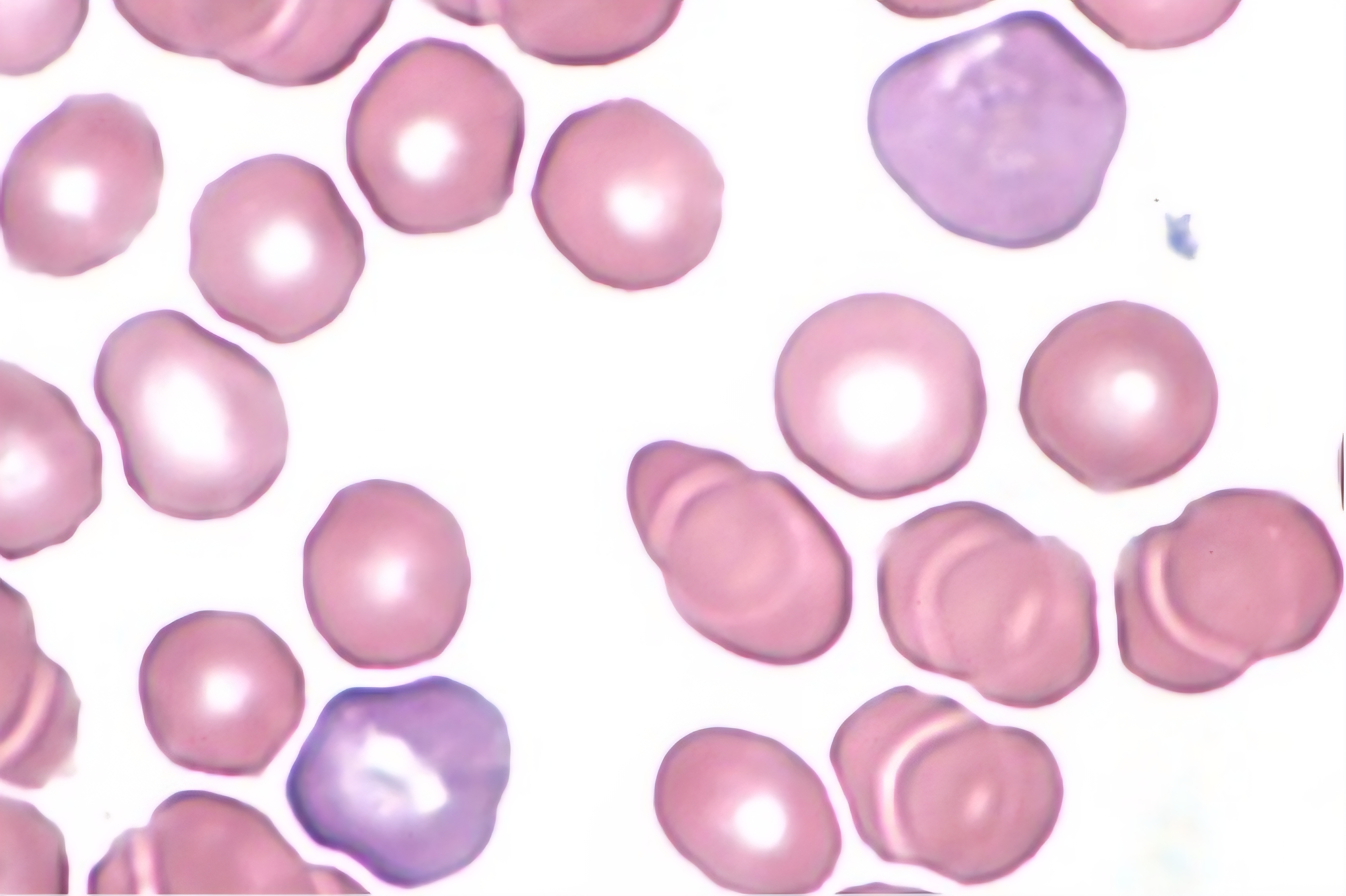 <p>RBCs with no central palor and bigger</p>