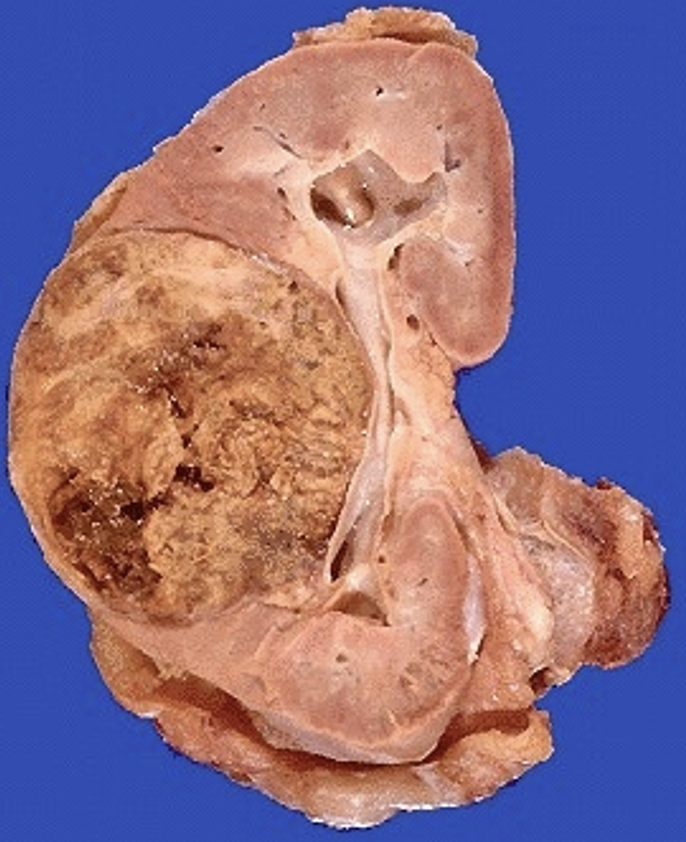 <p>What pathology is shown here?</p>