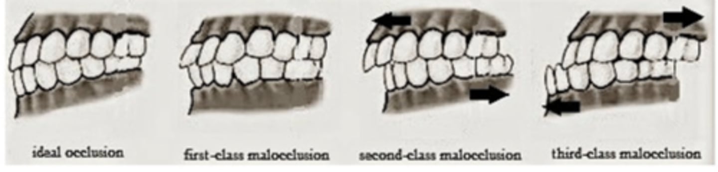 <p>Class I, Class II, Class III</p>