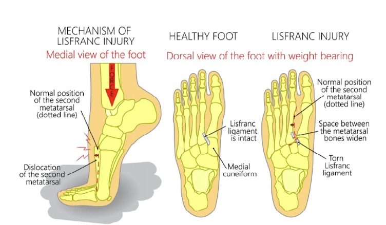 <p>Tearing of ligament between 1st and 2nd metatarsals and ½ of cuneiforms </p>