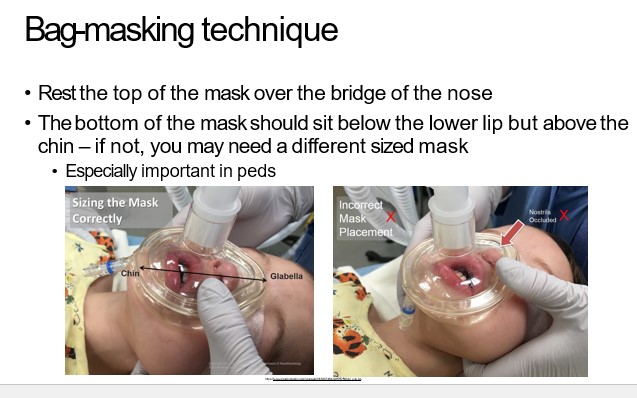   

•Rest the top of the mask over the bridge of the nose

•The bottom of the mask should sit below the lower lip but above the  chin – if not, you may need a different sized mask

•Especially important in peds 