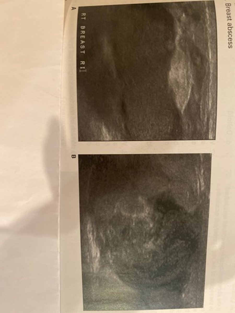 <p>The masses in Figure 14-41 were discovered in lactating patients who were suffering from focal breast erythema, swelling, fever, and pain. What is the most likely diagnosis?</p><p>a. Galactocele</p><p>b. Ganglion cyst</p><p>c. Intraductal carcinoma</p><p>d. Breast abscess</p>