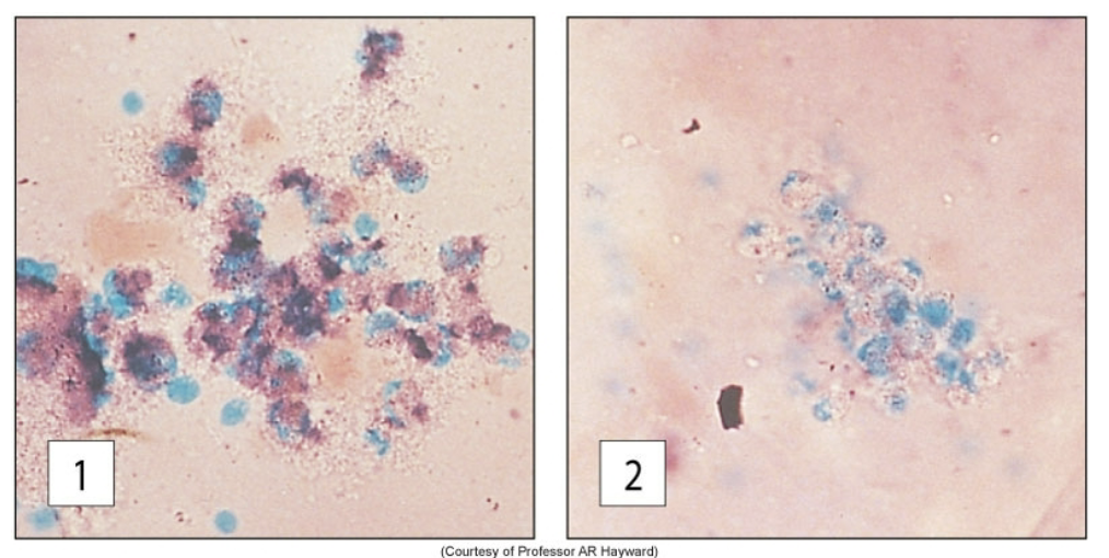 <p>this is an image of the results of 2 different patient samples that underwent the NBT dye test. which one is of the patient <strong>with CGD</strong>?</p>