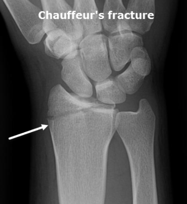 <p>What fracture is this?</p>