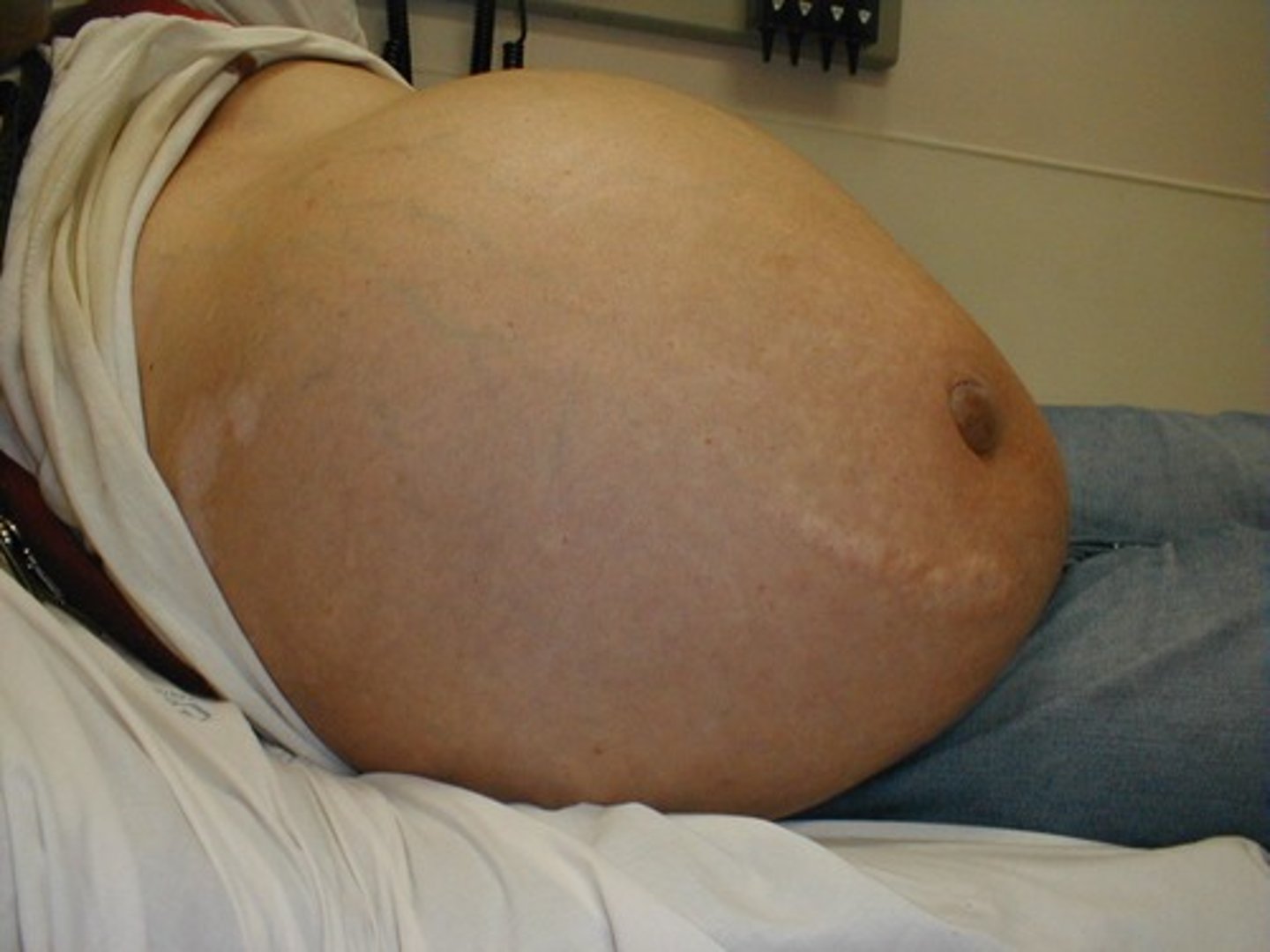 <p>1. Raised JVP<br>2. Ascites</p>