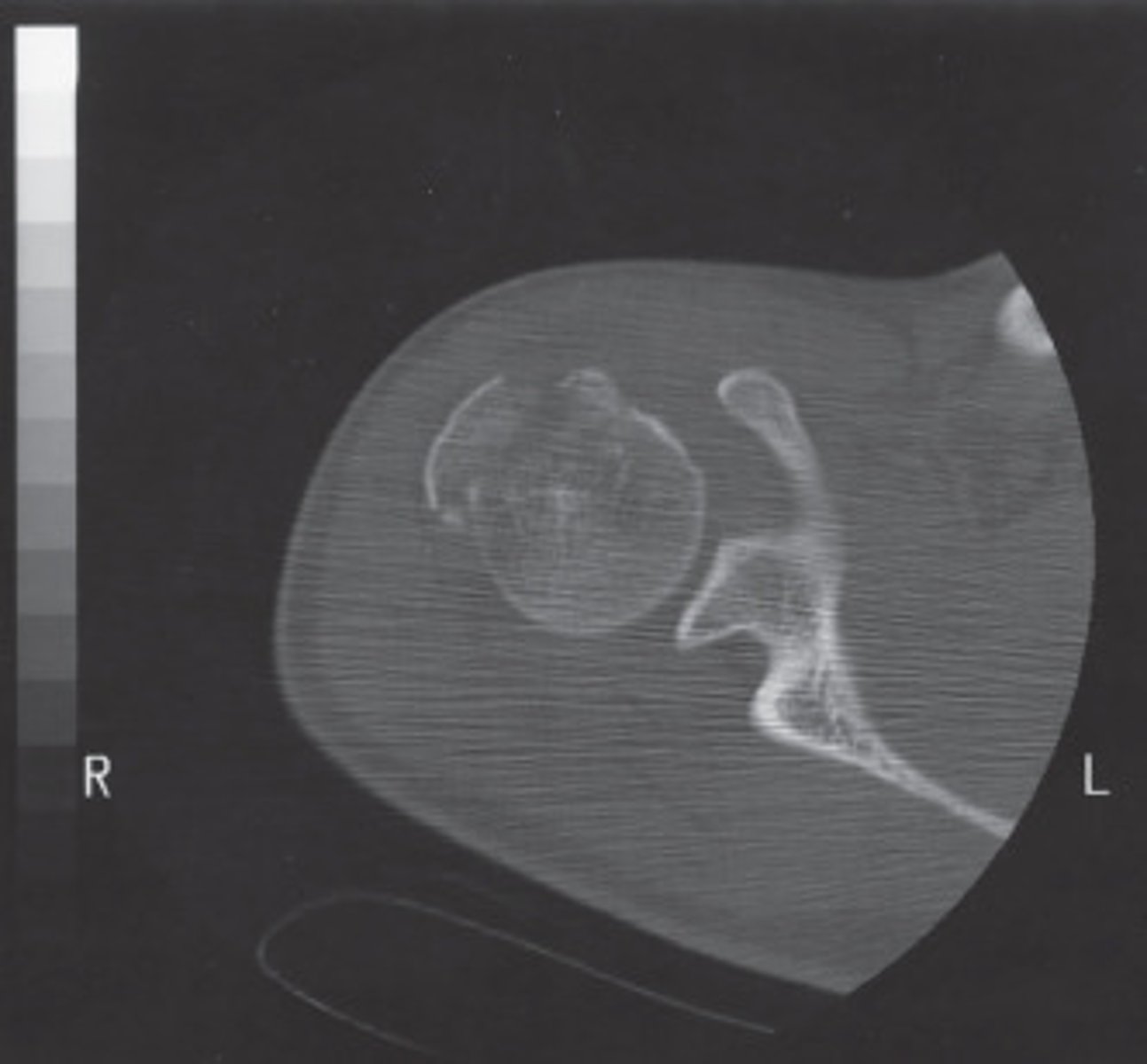 <p>The streaking artifact is most likely due to:</p>