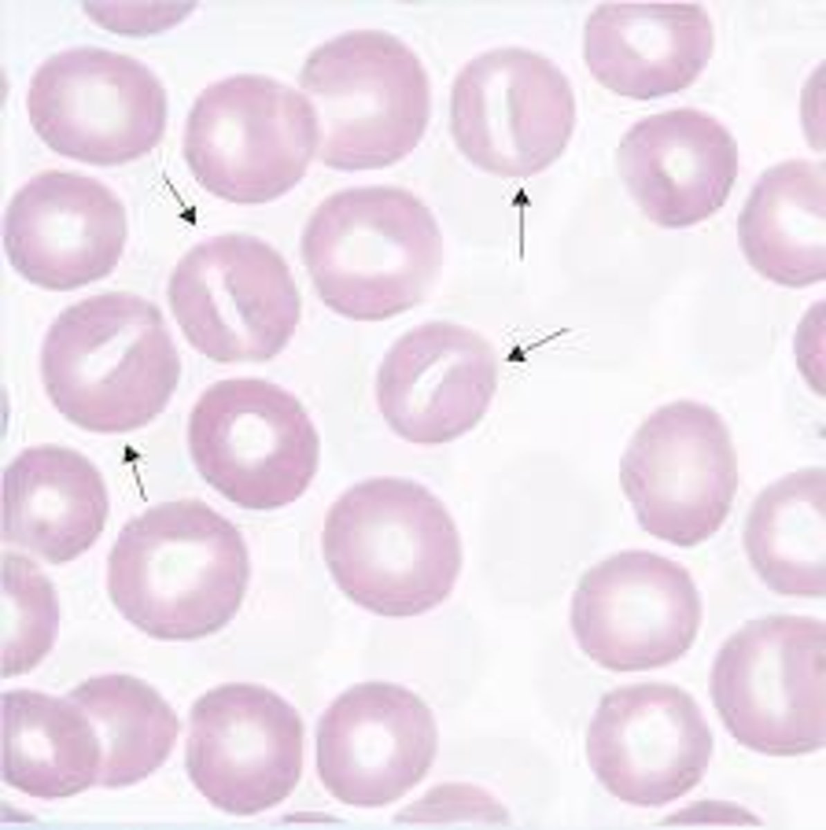 <p>- folded cell</p><p>- found in hereditary disorders</p>