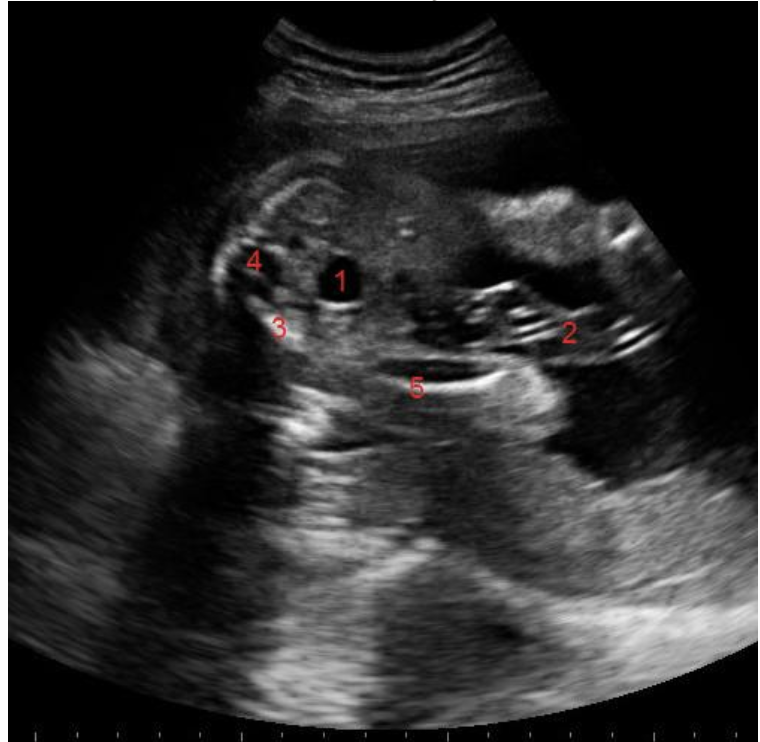 <p>what is #3</p><p>a) cord</p><p>b) sacral spine</p><p>c) pelvic bone</p><p>d) lumbar spine</p>