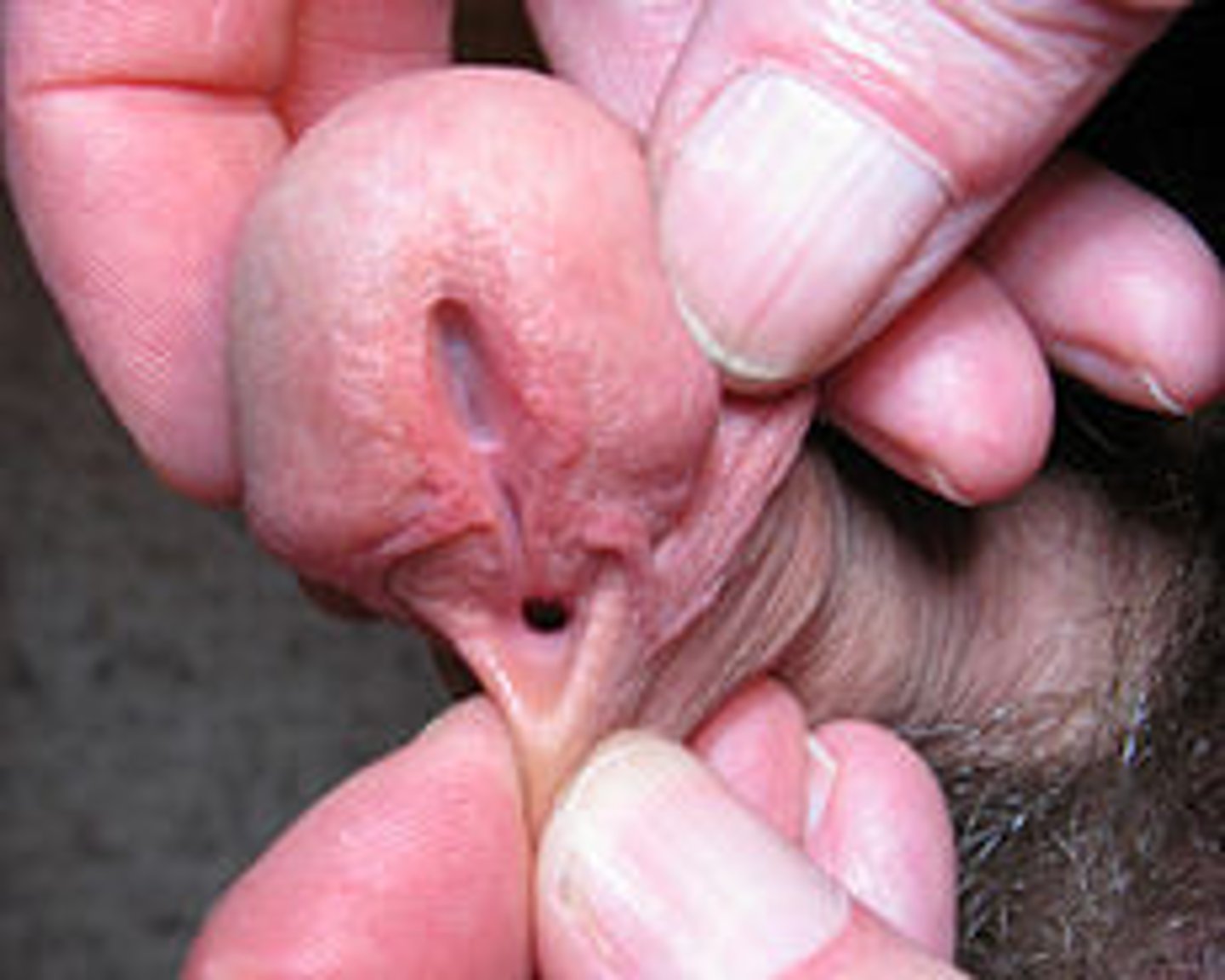 <p>Urethral opening on the ventral surface of the penis; circumcision is contraindicated</p>