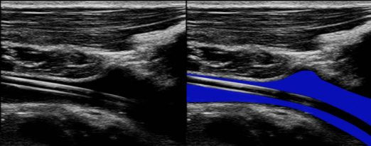 <p>This ultrasound image demonstrate intraluminal catheter. Color is traveling around catheter. Considering catheter placement, patient is at a higher risk for developing thrombus. </p>