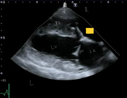 <p>Right Parasternal Long Axis View</p><p></p>