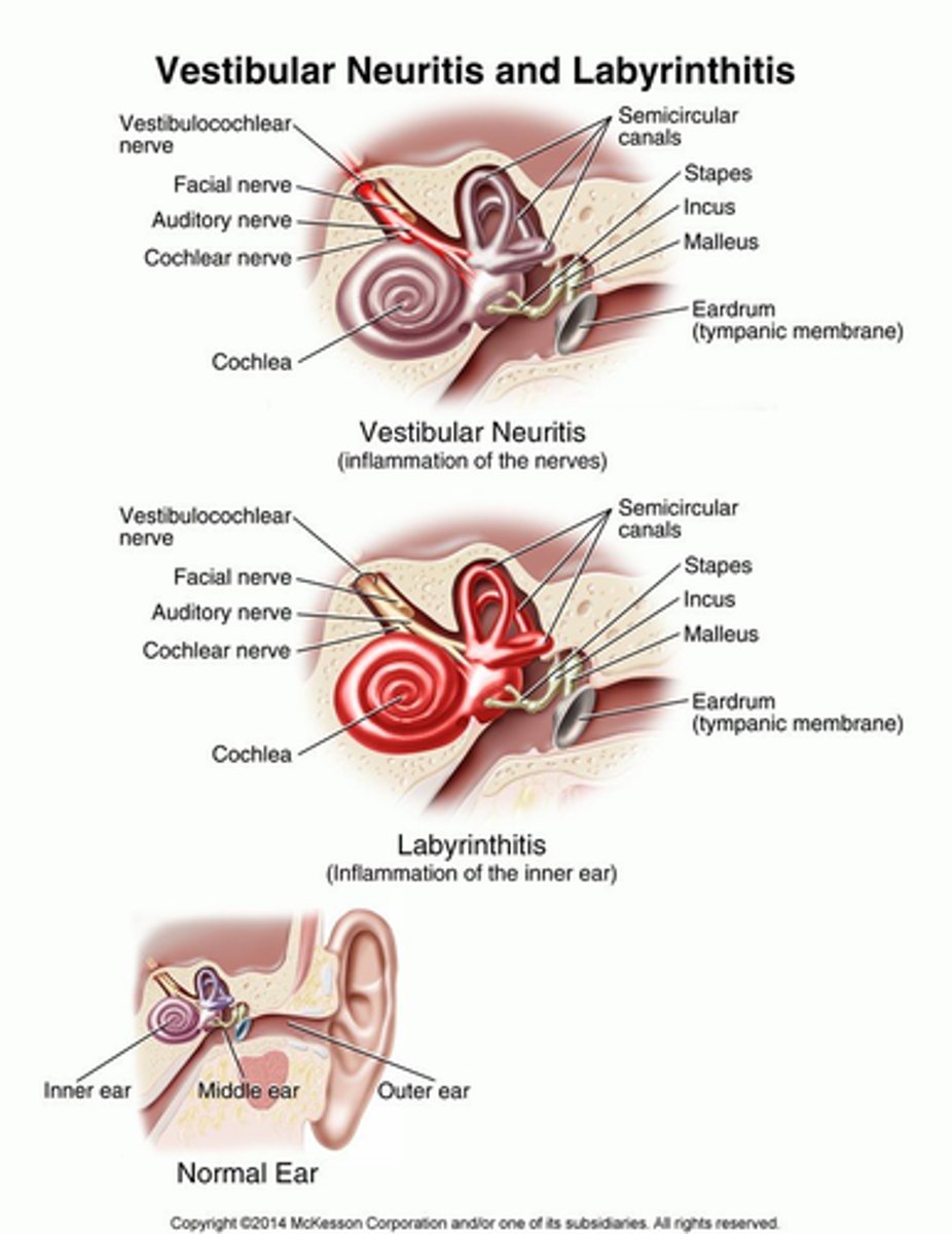 <p>Inflammation of the vestibular nerve which most commonly occurs after a viral infection (URTI)</p><p>Cause vertigo which can last for days</p>