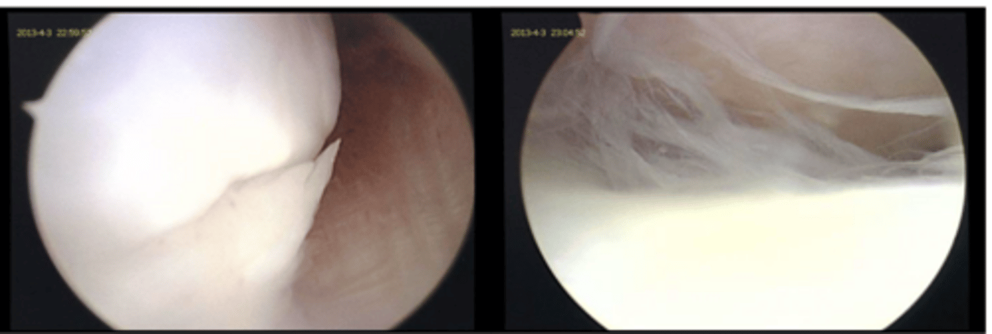 <p>how can we dx meniscal injuries</p>