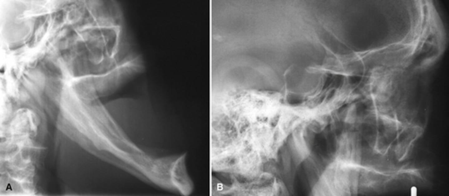 <p>This patient developed a class III skeletal relationship and enlargement of the sella turcica. What is the diagnosis?</p>