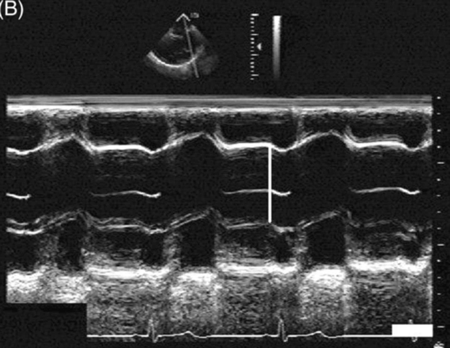 <p>larger than 1:1 ratio between LA and AOR with larger AOR</p>