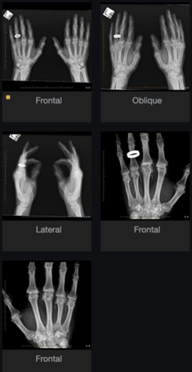 <p>Describe the findings on the hand x-rays</p>