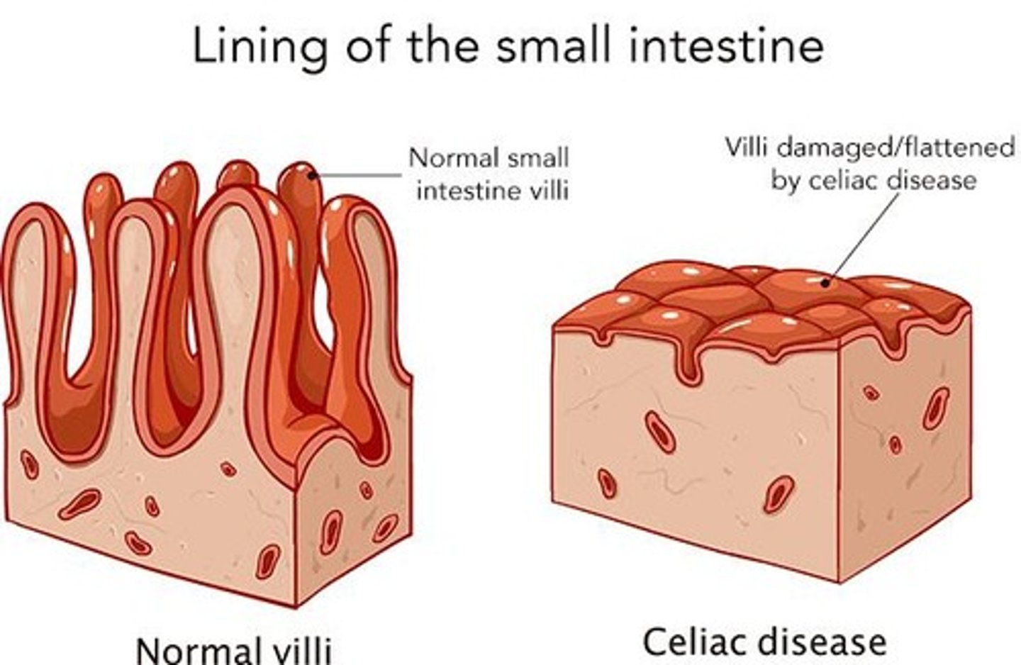 <p>An autoimmune disorder where gluten causes inflammation of the small intestine lining.</p>