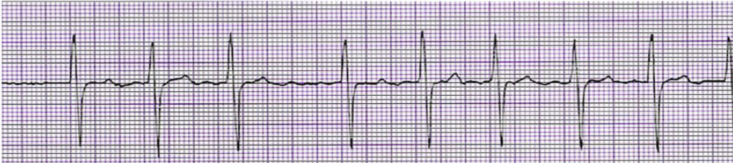 <p>What is this rhythm?</p>