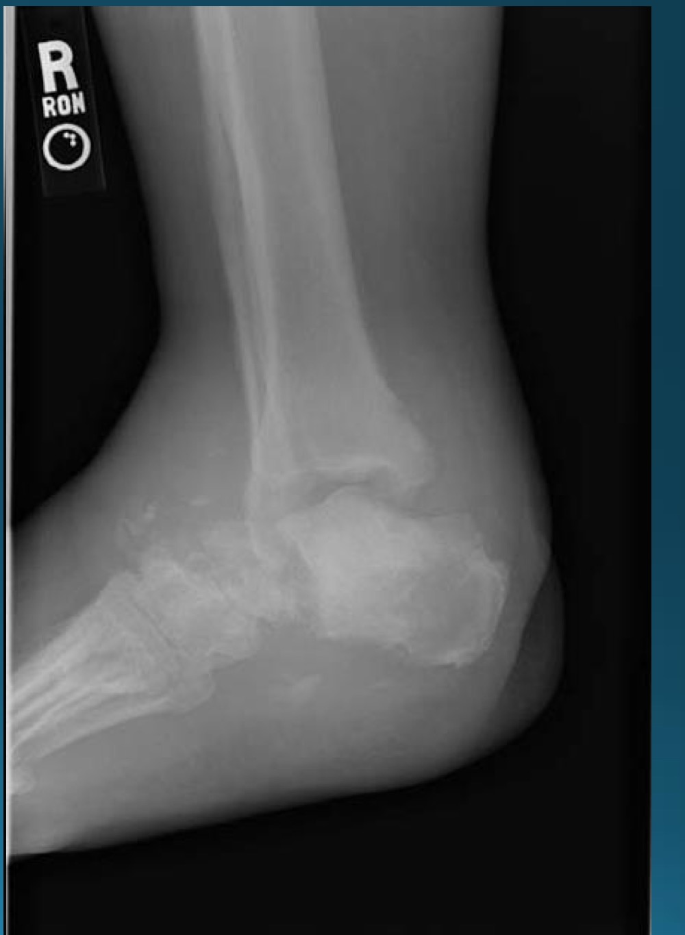 <p>what finding is in this image </p>