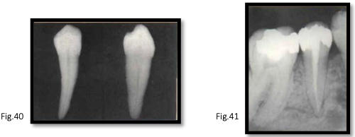 <p>canal anatomy of <strong>mn 2nd premolar</strong></p>