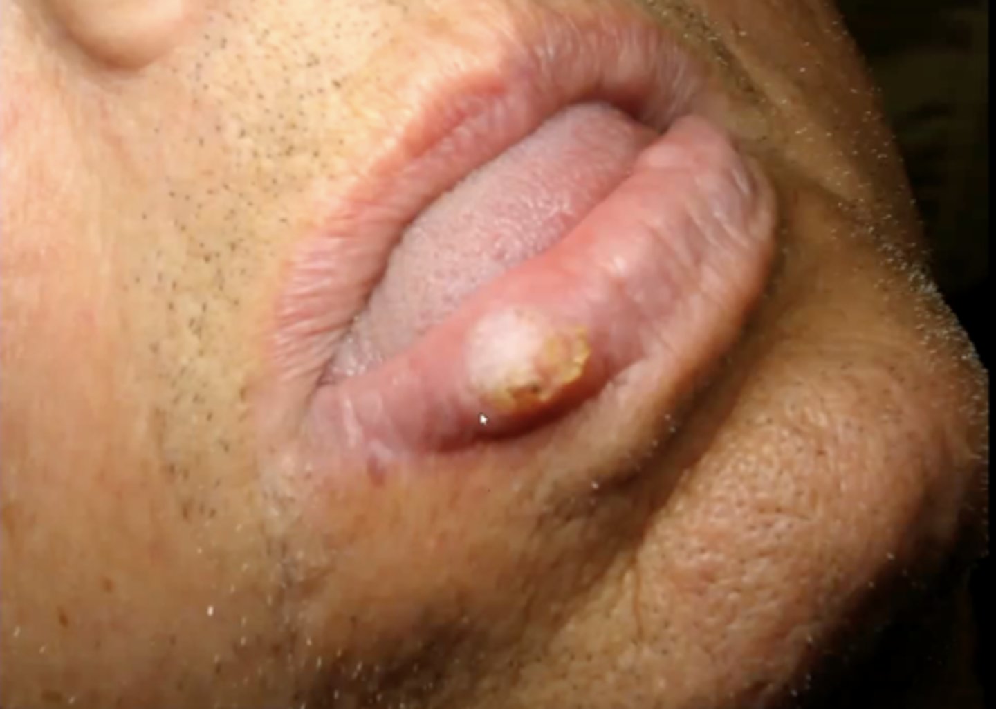 <p>a firm, non-tender, well-demarcated nodule with a central keratin plug that is caused by sun damage or HPV 26, 37</p><p>can look yellowish, brown or black</p>