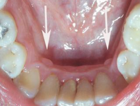 <p>sessile nodule located on the lingual surface of the mandibular cuspids. </p>