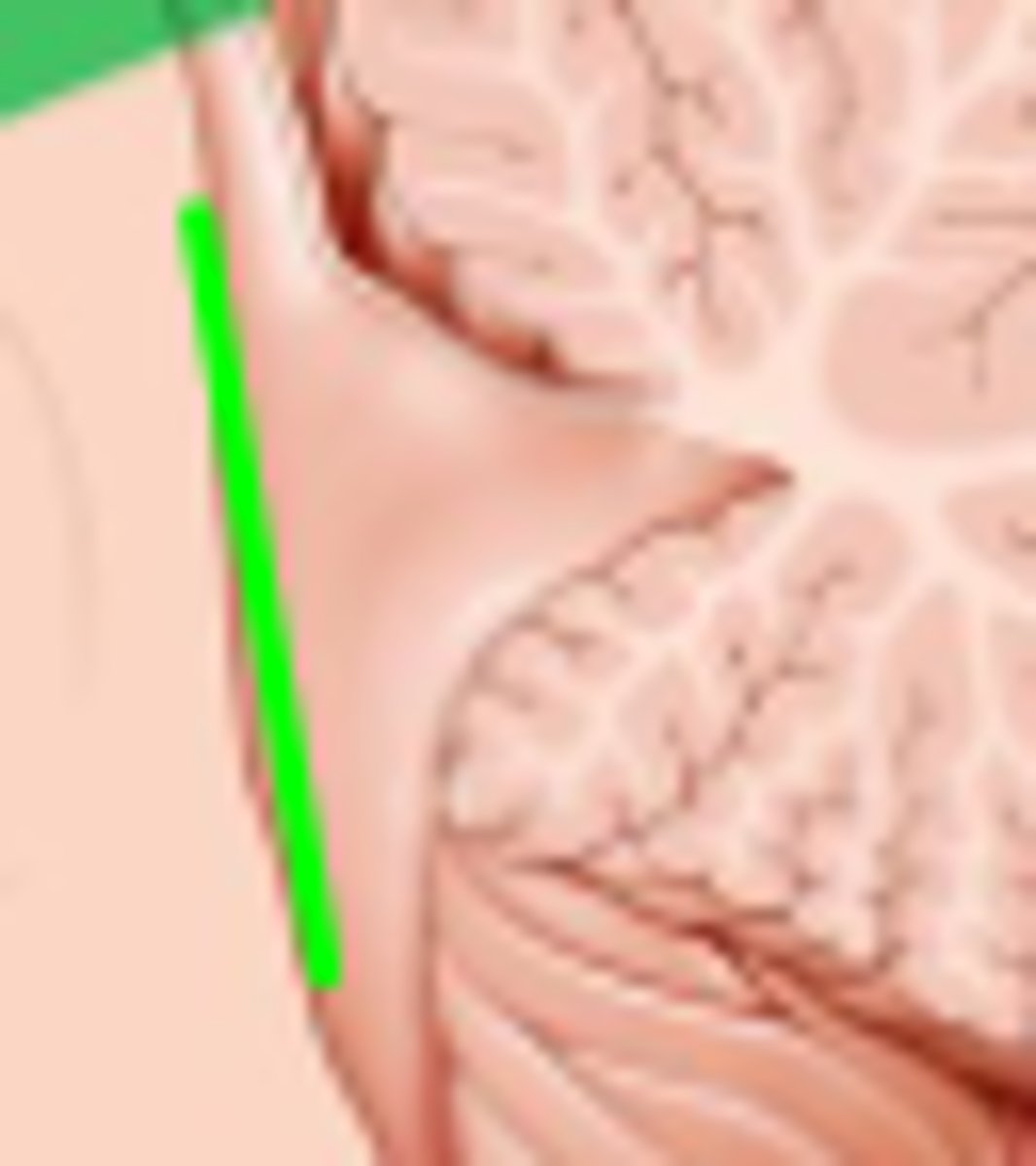 <p>Depression. Against pons /bottom of the triangle</p>