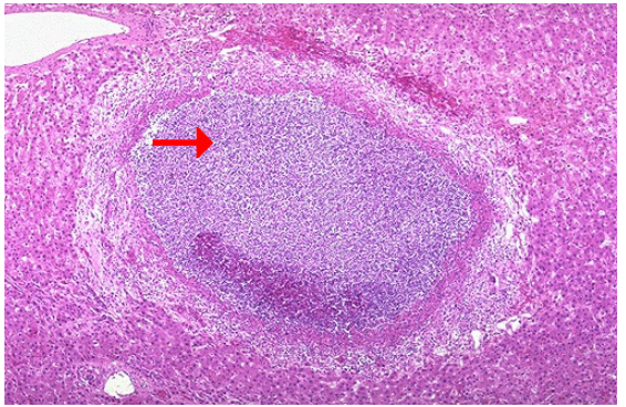 <ol><li><p>Identify the type of cell death and CD</p></li><li><p>What type of exudate is seen grossly?</p></li></ol><p></p>