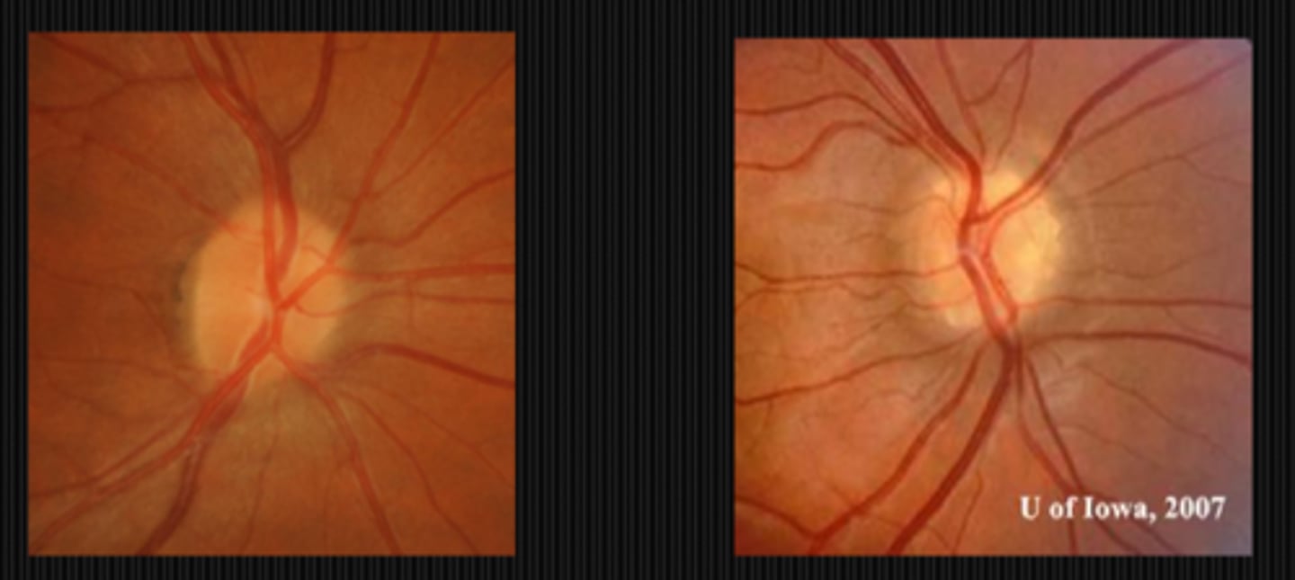 <p>papilledema = blurred sup and inf</p><p>drusen = symmetric, scalloped blur</p>