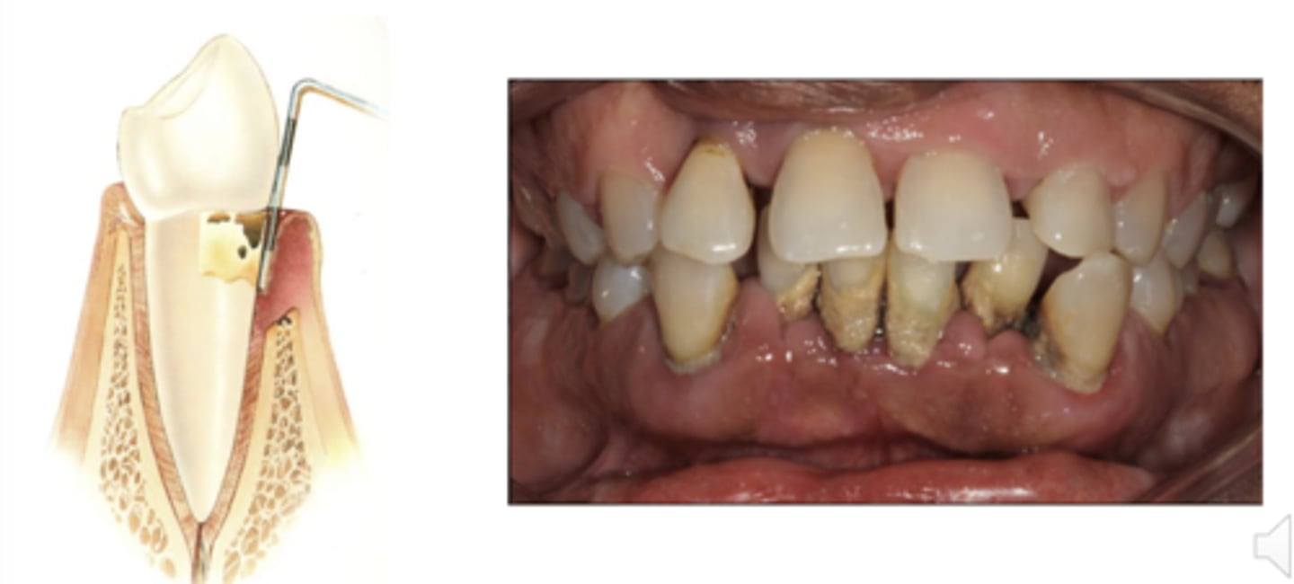 <p>Presence of inflammation at the sites where there is loss of alveolar bone and connective tissue</p>