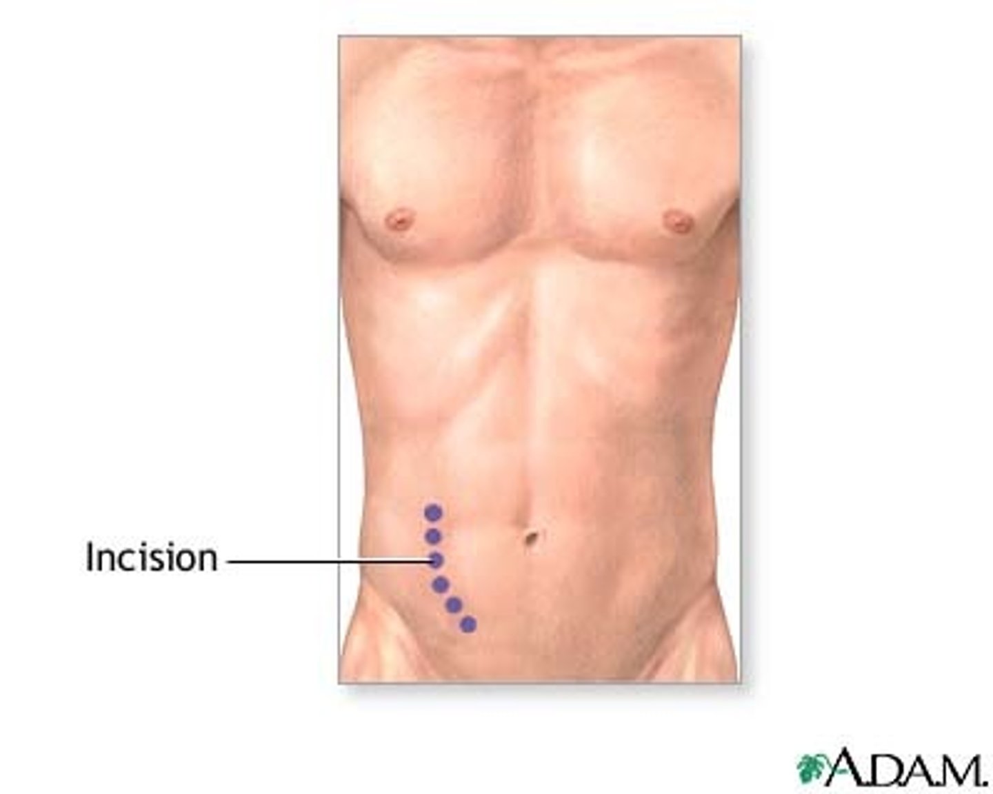 <p>lower quadrant, kidney is placed <span style="color: red;"><strong>extraperitoneally</strong></span></p>