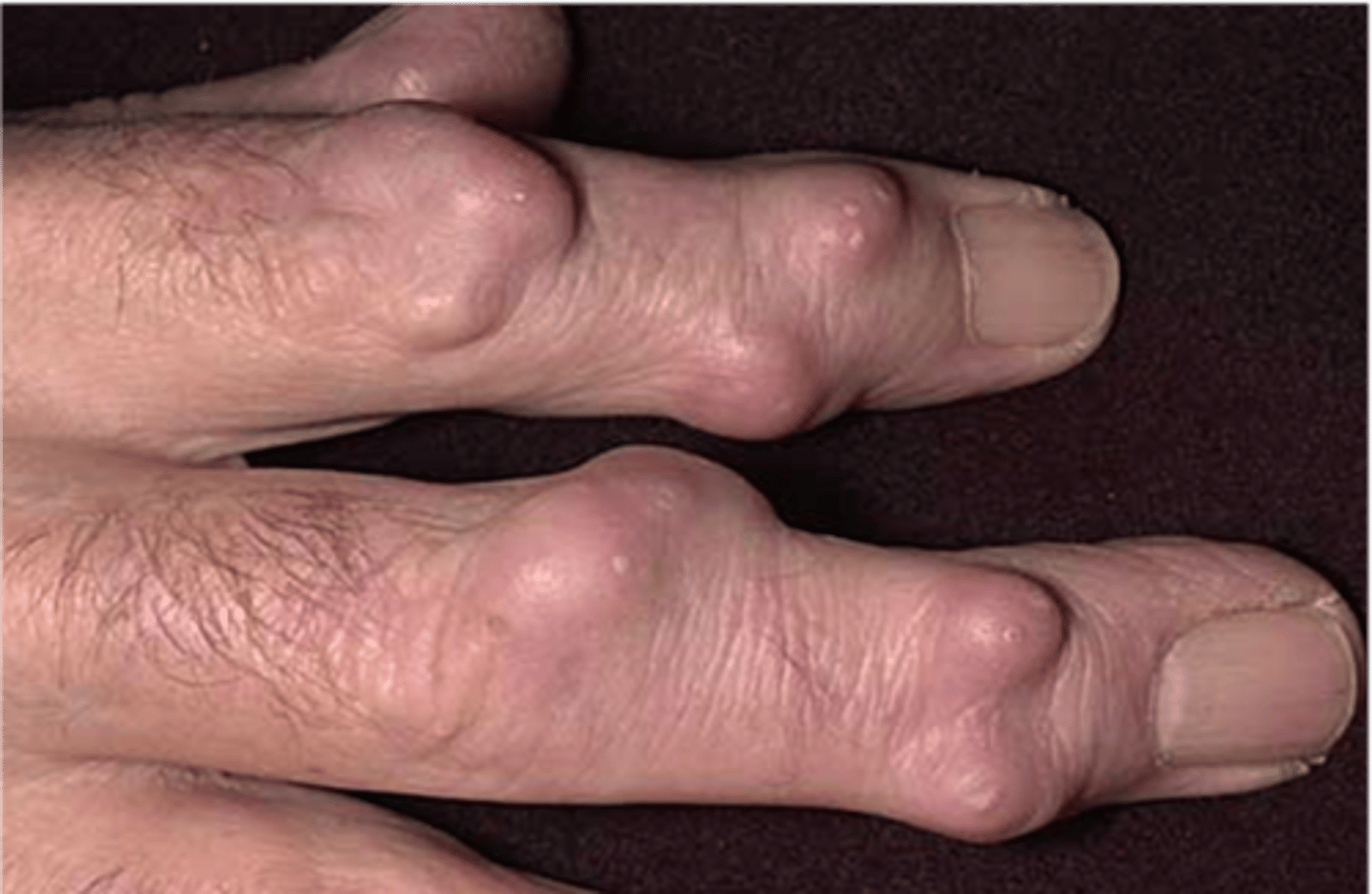 <p>____________:</p><p>• Solid, circular lesion</p><p>• &gt; 1 cm</p><p>• Usually invades the epidermis &amp; lower dermis</p>