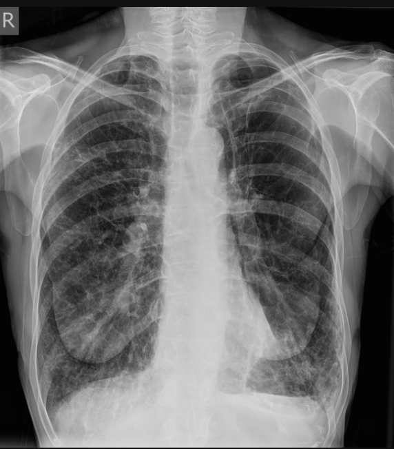 <p>On an AP view CXR positive for COPD what are our red flags?</p>