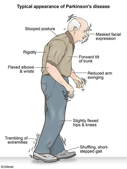            

* Classic Triad

          -Resting Tremor

           -Rigidity

           -Bradykinesia

\
**S** huffling gait

**M** ask like

**A** kinesia (delayed response or freezing mid action)

**R** idgity

**T** remor

\
      