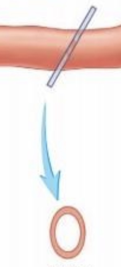 <p>a <strong>cut made across the long axis</strong> at other than a right angle</p>