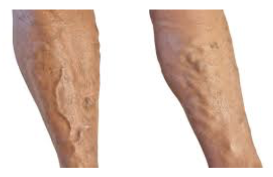 <ul><li><p><strong>EFFECT</strong> </p><ul><li><p>Dilated and painful veins due to incompetent (leaky) vavles </p></li></ul></li><li><p><strong>CAUSE</strong></p><ul><li><p>Factors that contribute include heredity and conditions that hinder venous return </p></li><li><p>Prolonged standing, obestity, pregancy </p></li><li><p>Elevated venous pressure </p></li><li><p>Straining to deliver a baby or have movement raises intra-abdominal pressure → resulting varicosities in anal veins called hemorrhoids </p></li></ul></li></ul><p></p>