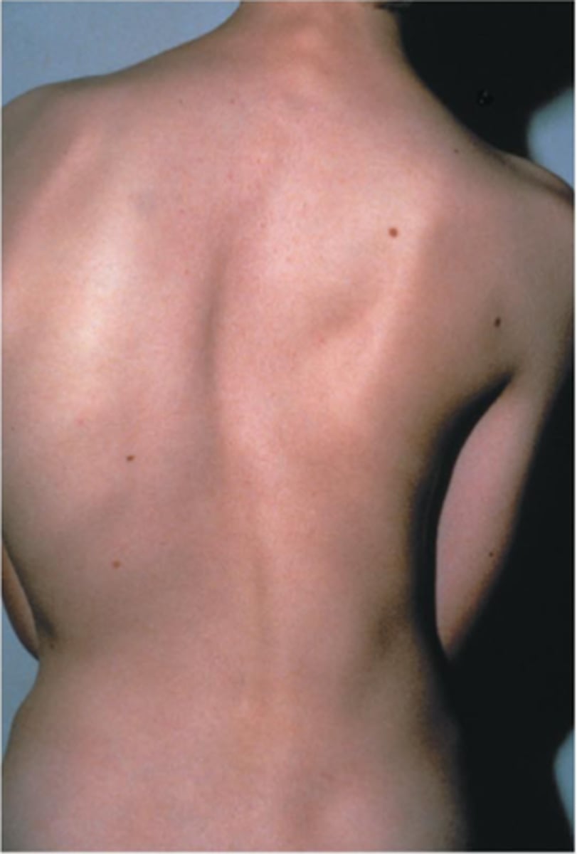 <p>abnormal lateral curve</p>