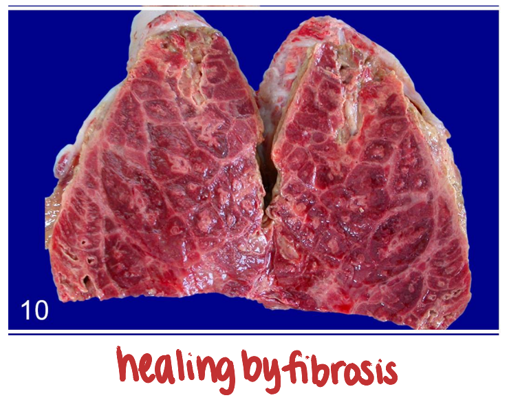 <ul><li><p><strong><u>obstruction of bronchiolar lumen by connective tissue</u></strong> following severe damage to bronchioles and alveoli</p><ul><li><p>healing by <strong><u>fibrosis</u></strong></p></li></ul></li><li><p>blocks airflow to alveoli, reduces vital capacity</p></li></ul><p></p>