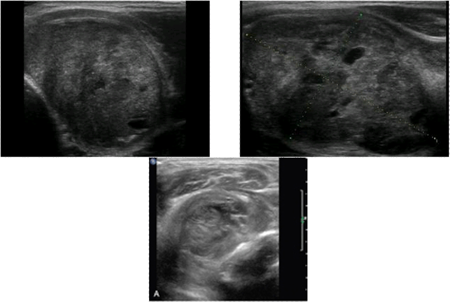 <p>large, solid, hypoechoic</p><p>aggressive, can compress local structures of the neck</p><p>rare, &lt;10 % survive after 5 years, no effective therapy</p>