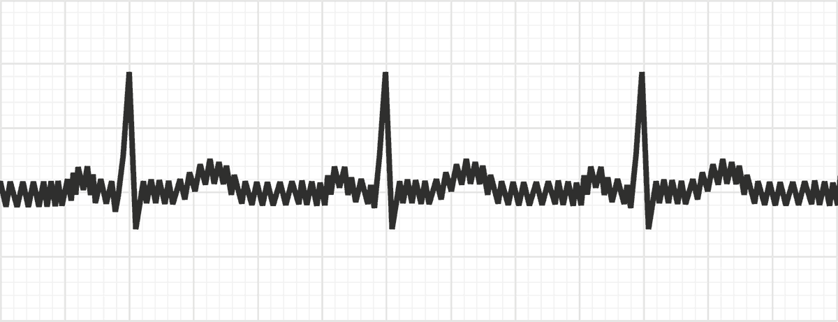 <ul><li><p>caused by poor grounding and external electricity interfering with tracing</p></li></ul><p></p>