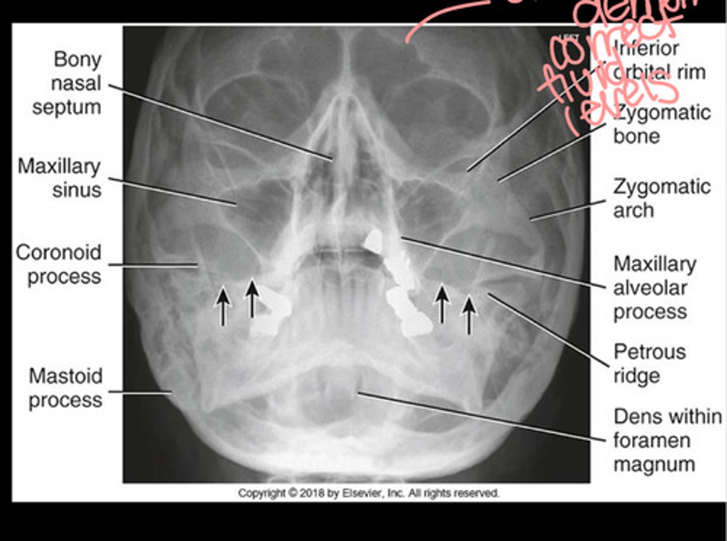 <p>Maxillary sinuses</p>